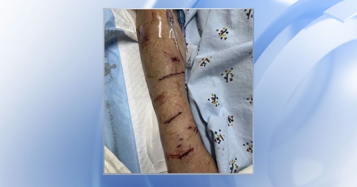 Rabid fox bites Raleigh woman, marking third bite incident this month