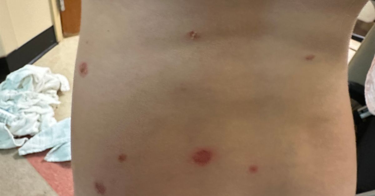 Rare, painful skin condition sends multiple kids to WakeMed hospital :: WRAL.com