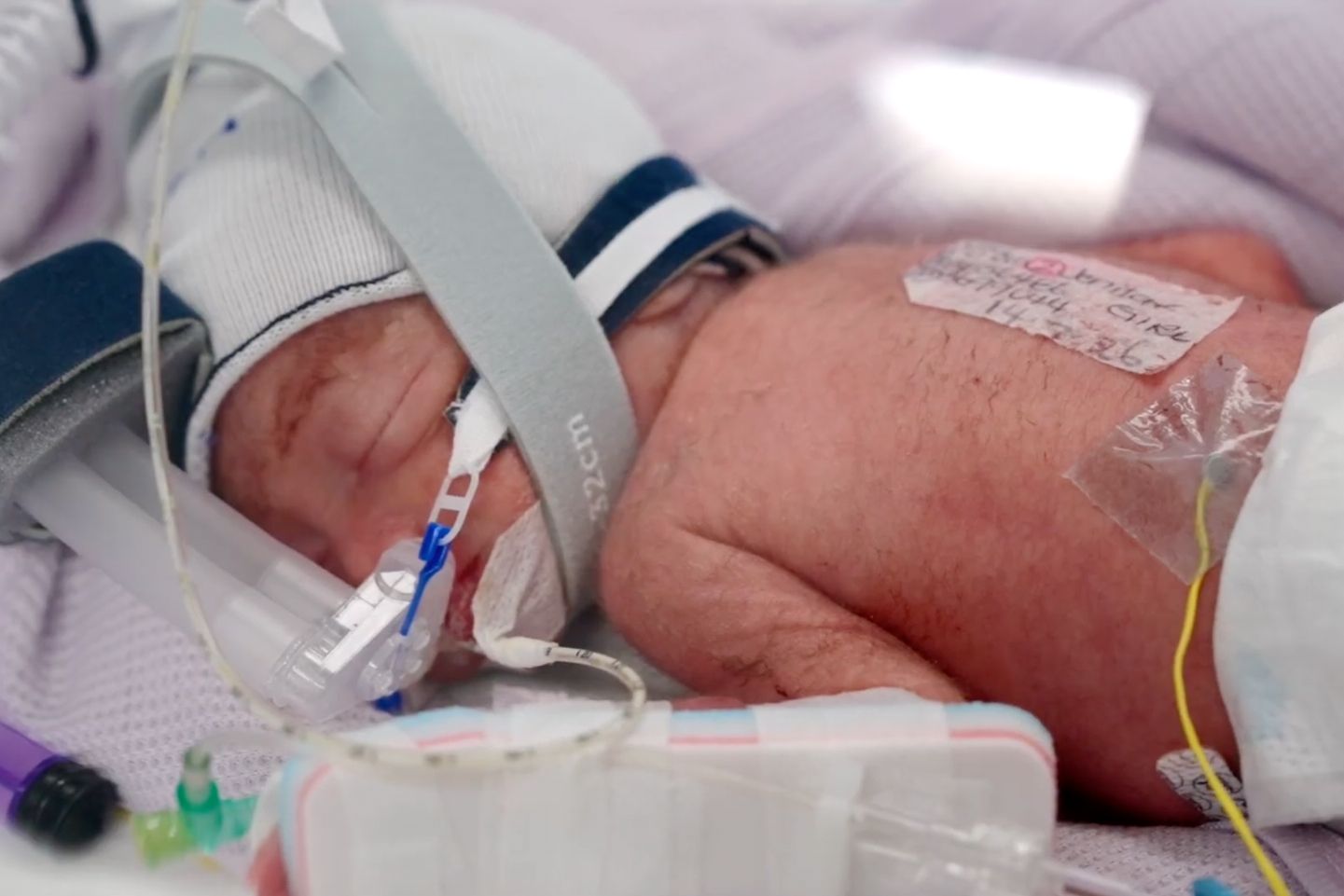 After an extremely rare pregnancy, an Australian woman gives birth to identical quadruplet girls