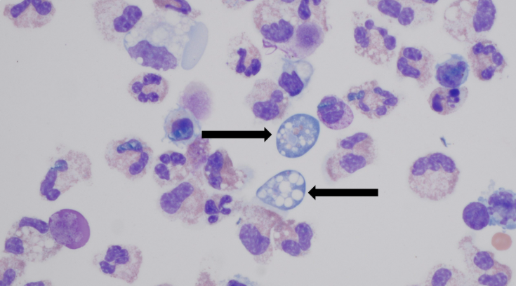 NC teen critically ill with 'brain-eating' amoeba found in warm, fresh water