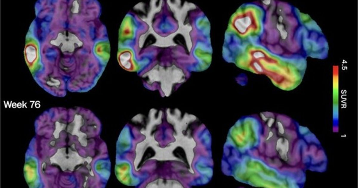 An experimental Alzheimer's drug shows promise targeting a different brain protein, new study shows