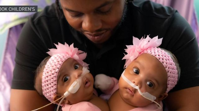Conjoined twin girls, who shared a liver, separated 