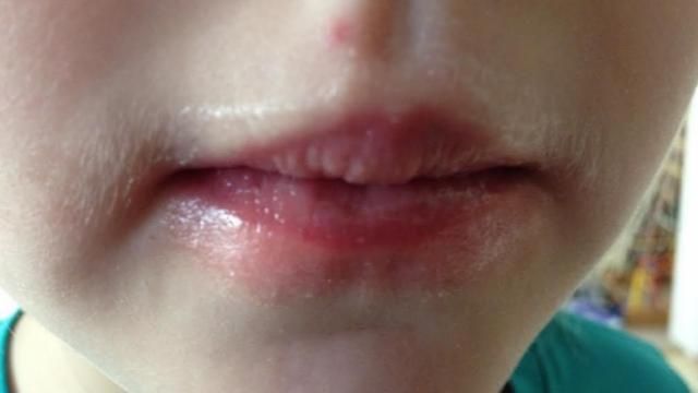 Blisters on the tongue: Pictures, causes, and treatments