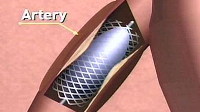 New Guidelines Issued for Stent Use