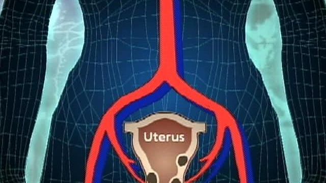 New Treatment for Fibroid Tumors Growing in Popularity