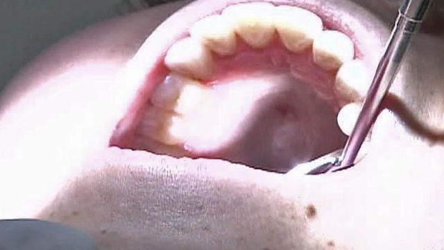 Palate Can Provide Tissue to Repair Gums