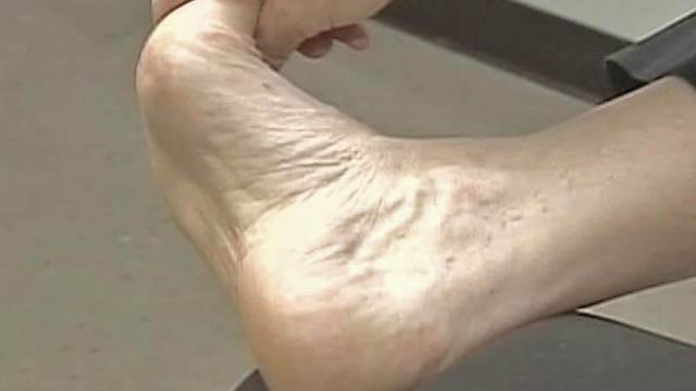 Ease Heel Pain With Simple Stretching Technique