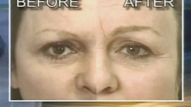 Follicle Transplant Can Restore Eyebrow Hair Loss