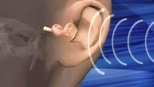 Woman Credits Double Cochlear Implants for Renewed Life