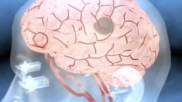 UNC Researchers Testing Laser for Stroke Victims