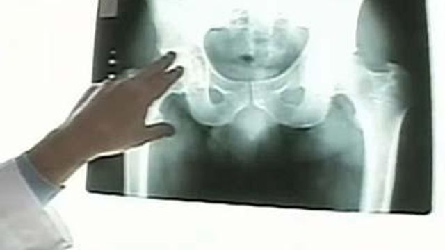 Less Invasive Treatment Gives Relief to Hip Pain Sufferers