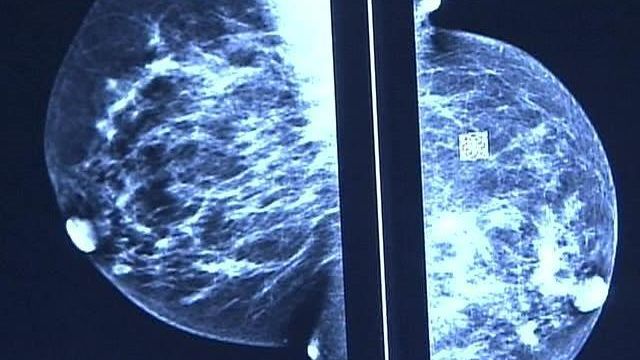 Health Officials: BSGI Breast Cancer Scan is Easier, Less Expensive