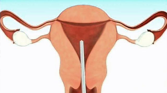 New Procedure Makes Birth Control Permanent