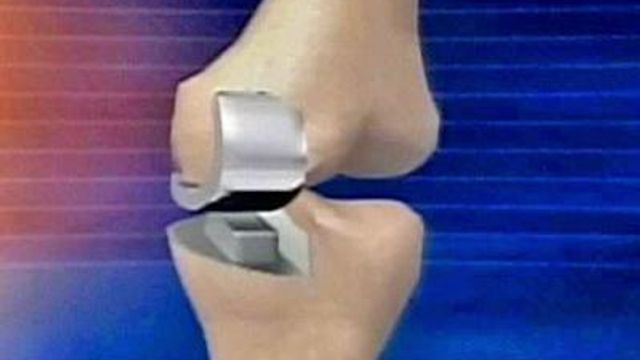  New Knee Surgery Gets Patient Moving Again Faster