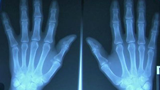 UNC researchers study osteoarthritis links