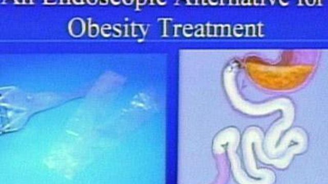 Procedure offers surgery-free alternative to gastric bypass