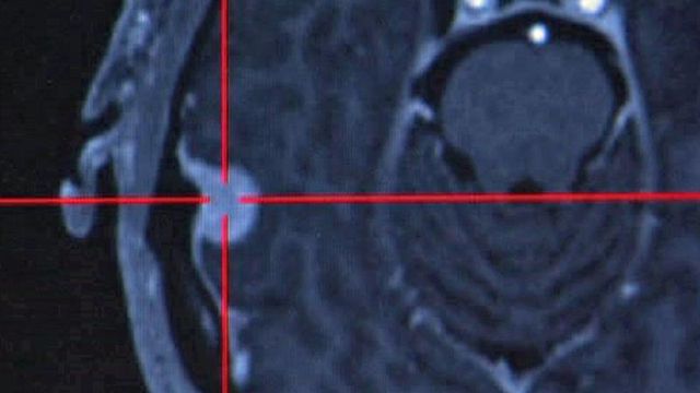 New device makes brain surgery safer