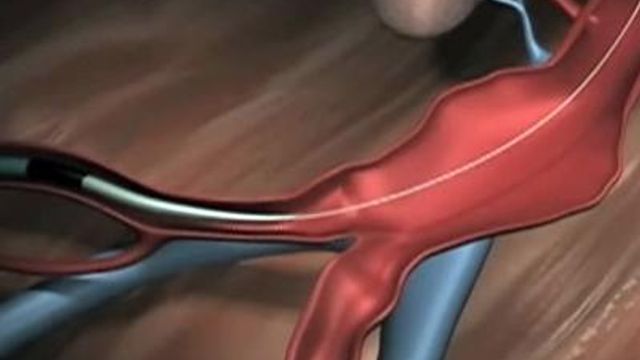 Abdominal aneurysms common, deadly, treatable