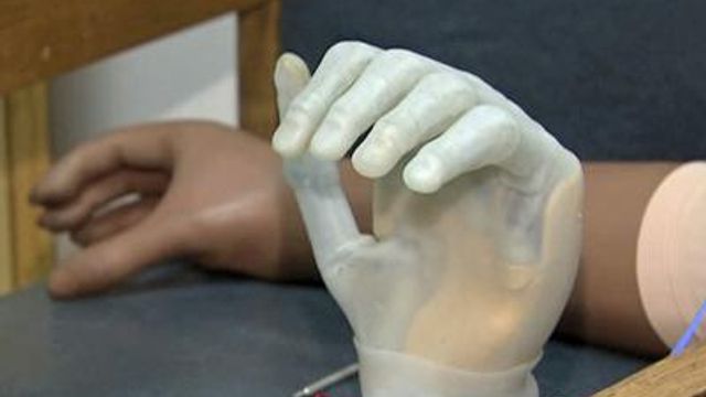 High-tech advances improving prosthetics