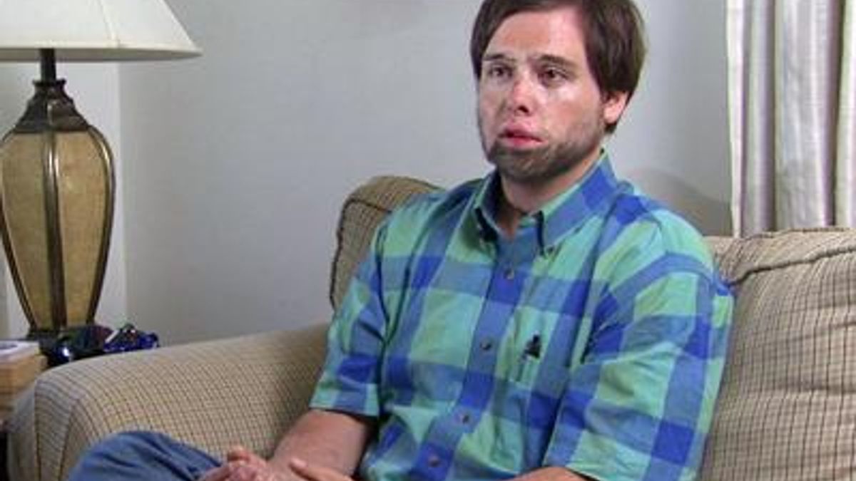 Carrboro man recalls treatment at Jaycee Burn Center