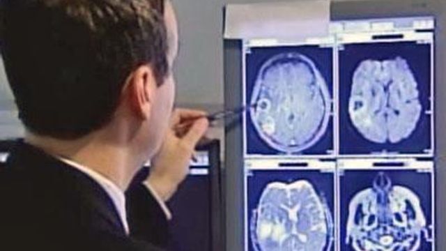 Brain scan could help cancer patients