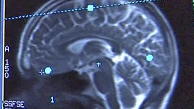 Study focuses on Alzheimer's disease