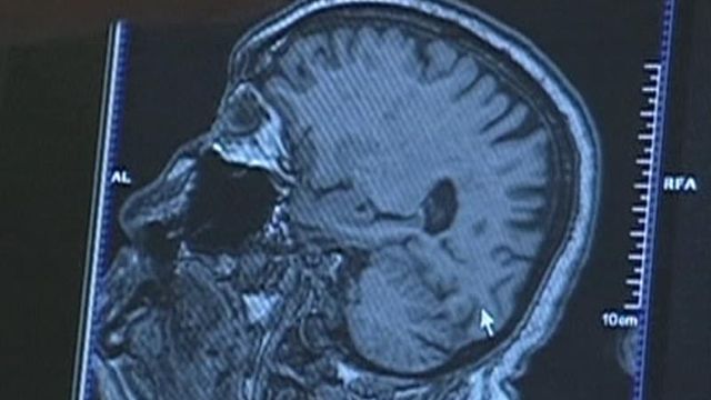 Long-term study identifies healthy brain marker