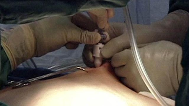 Study: Volume of bariatric surgeries determines complication rate