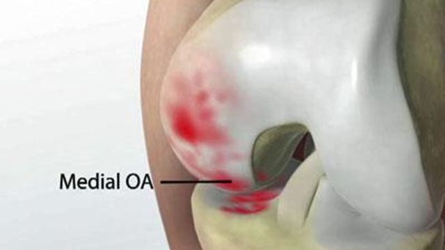 Robotic arm repairs knee joints
