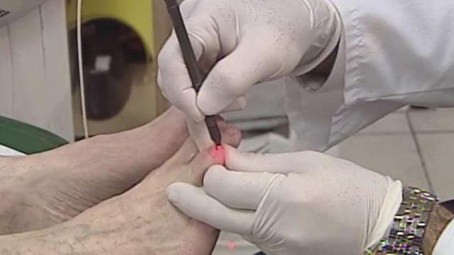 Laser treatment can help rid toes of painful fungus