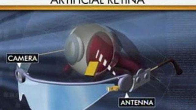 Artificial retina gives sight to the blind