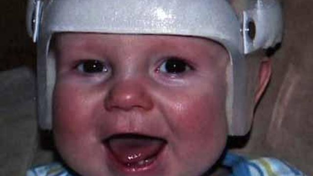 Raleigh infant has skull surgery