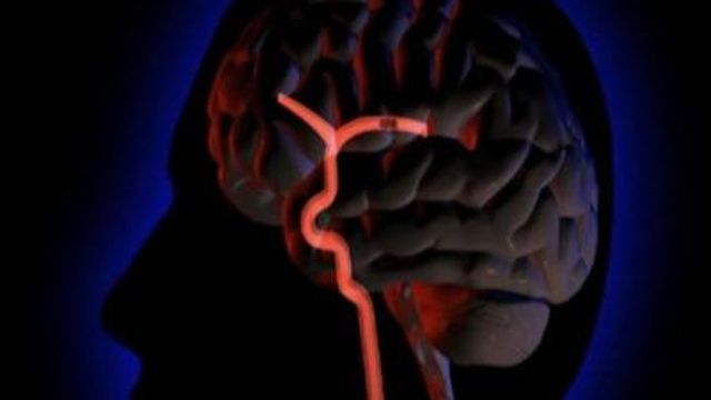 Brain stents may increase risk of stroke