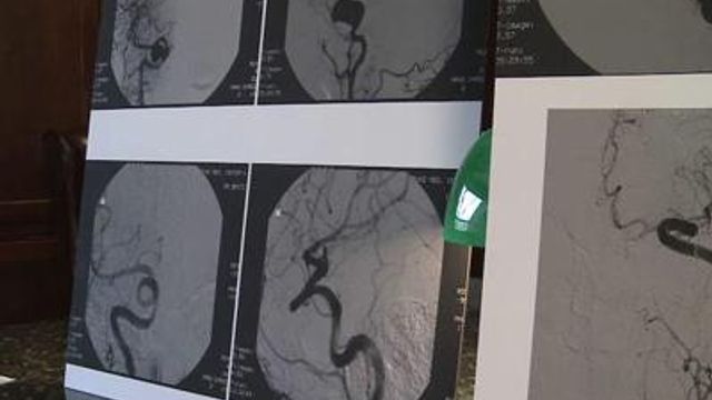 New procedure offers less invasive fix for aneurysms