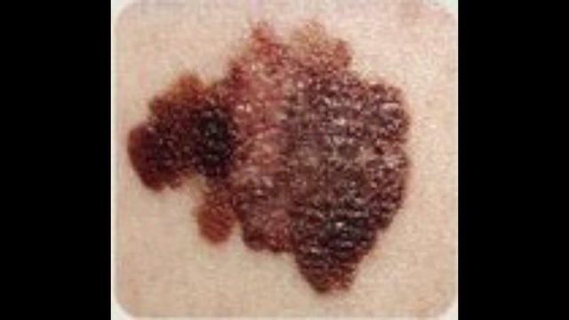 Study targets most deadly skin cancer
