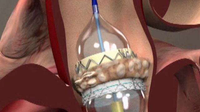 New heart valve stent gives elderly patients options