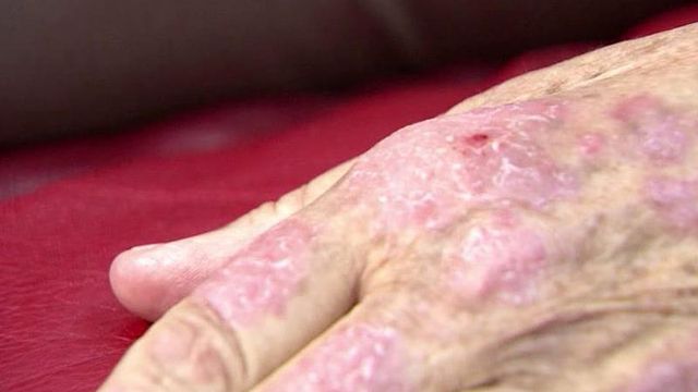 Easy treatment for psoriasis also shows heart health benefits