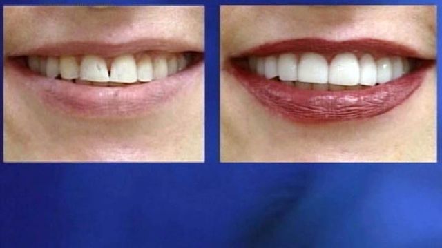 Say cheese: Gum lift produces bigger smiles