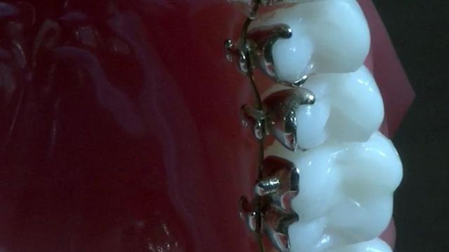 Want straight teeth without a smile full of wire? Try lingual braces
