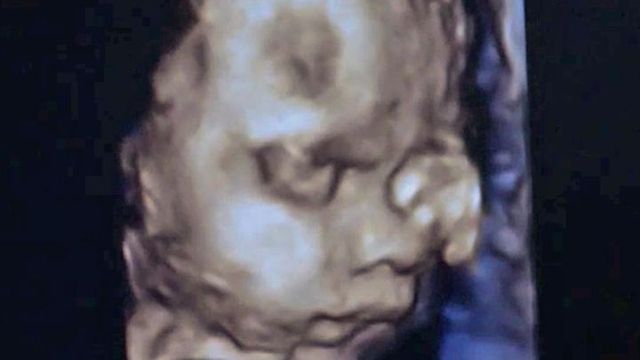 Couple says 3-D ultrasound makes unborn baby 'more real'