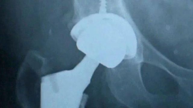 New tech makes hip replacements easier