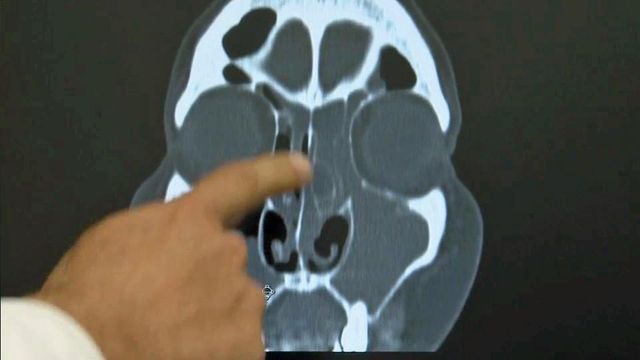 New implant may help those with sinusitis