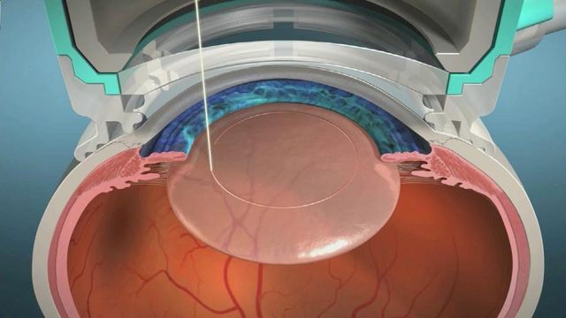 Cataract patients find benefit in laser surgery