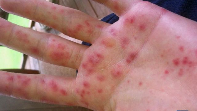 Rash is telltale sign of hand, foot and mouth disease