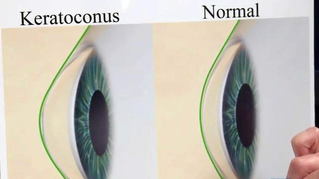 Keratoconus changes shape of eye's cornea