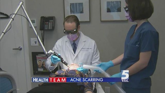 New laser promises smoother skin in fewer treatments