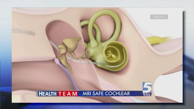 MRI-safe cochlear implant now available