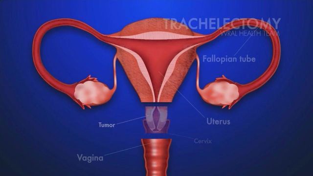 Surgical procedure preserves fertility for cervical cancer patients
