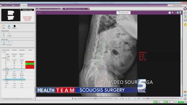 New surgical procedure available for patients with scoliosis