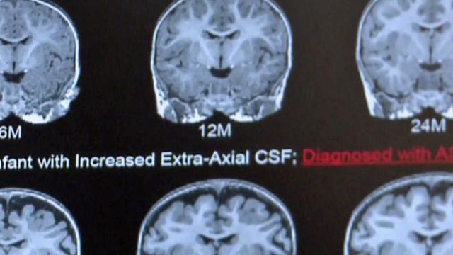 Brain abnormality could indicate autism risks
